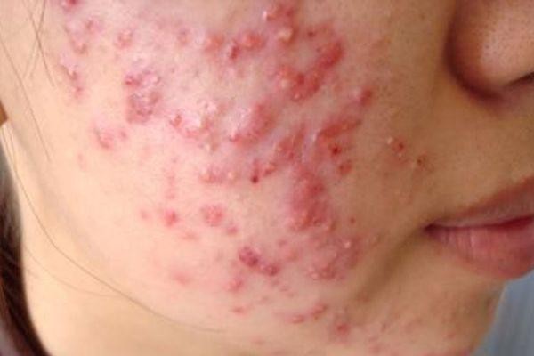 Cách sử dụng 3 hoạt chất thường dùng bôi trị mụn trứng cá- Ảnh 3.