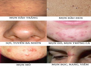 Cách nhận biết các loại mụn trên da bạn nên hiểu để điều trị đúng cách