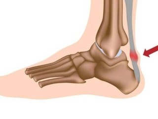 Viêm gân gót chân Achilles: “Kẻ thầm lặng” đứng sau những bước chân đau đớn