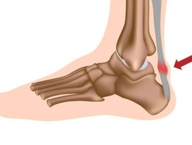 Viêm gân gót chân Achilles: “Kẻ thầm lặng” đứng sau những bước chân đau đớn